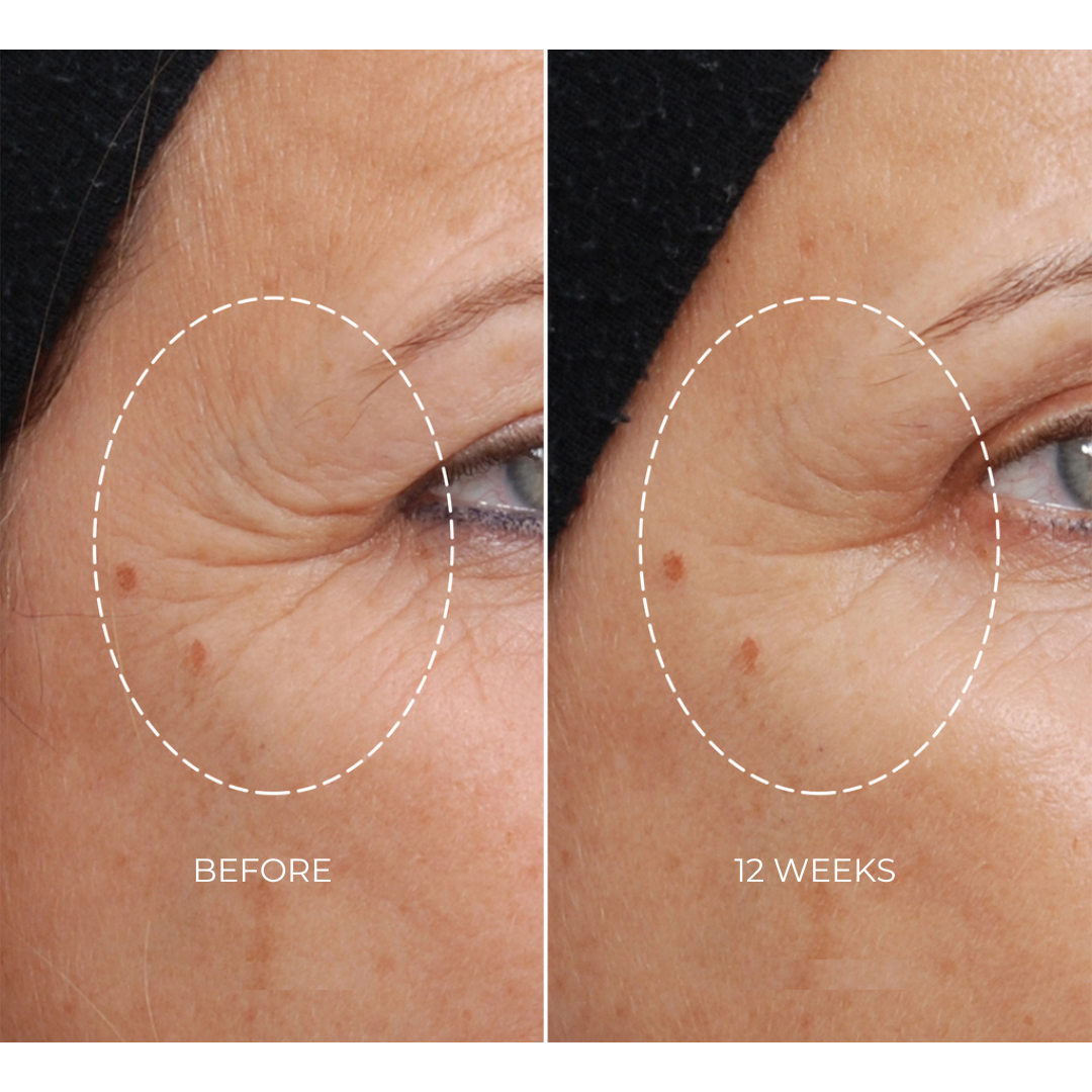 NEWA Classic RF Wrinkle Reduction Device