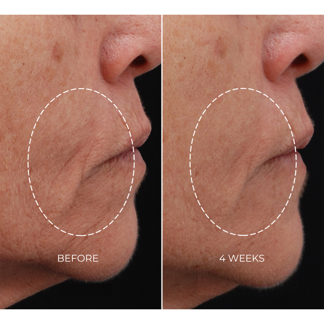 NEWA Classic RF Wrinkle Reduction Device