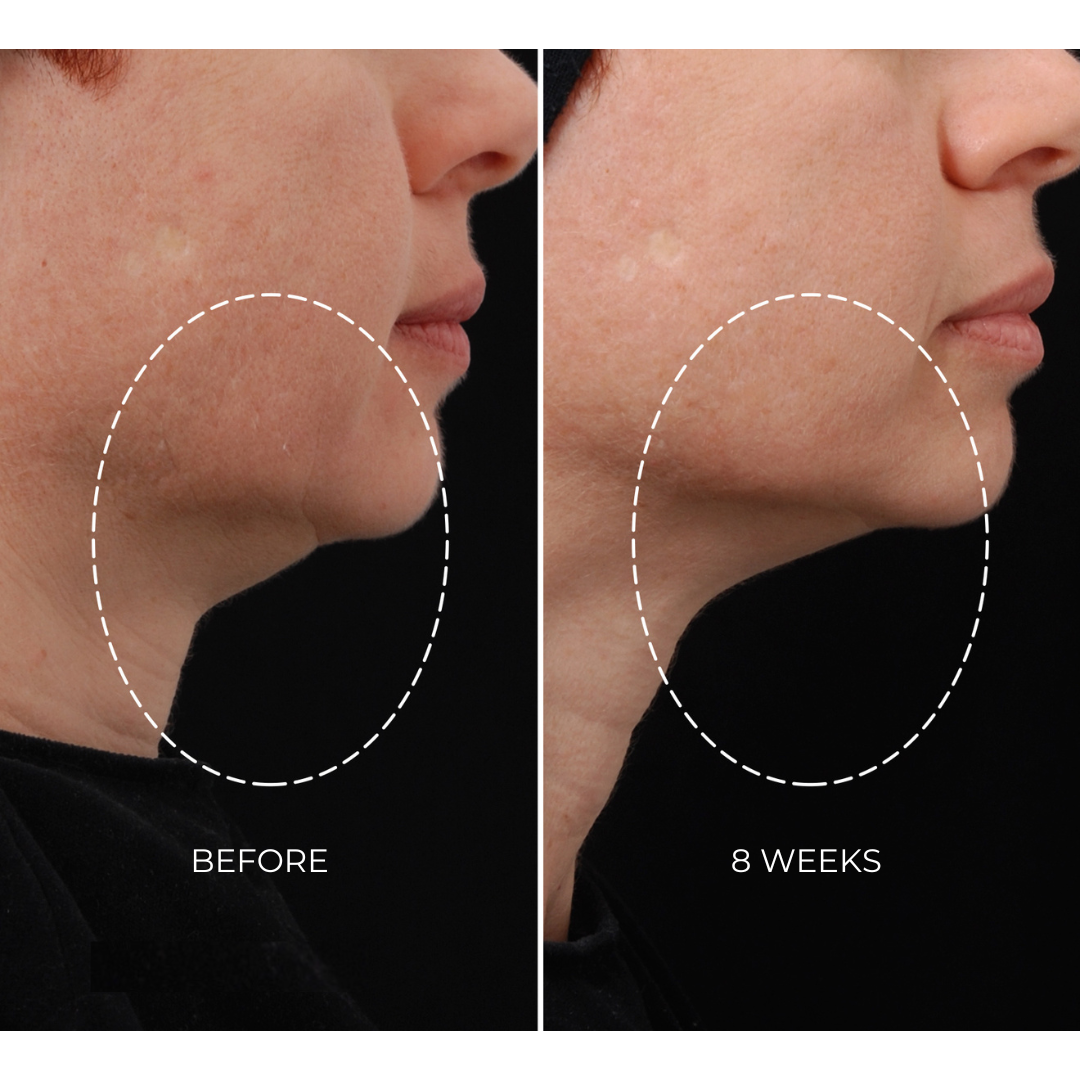 NEWA Classic RF Wrinkle Reduction Device