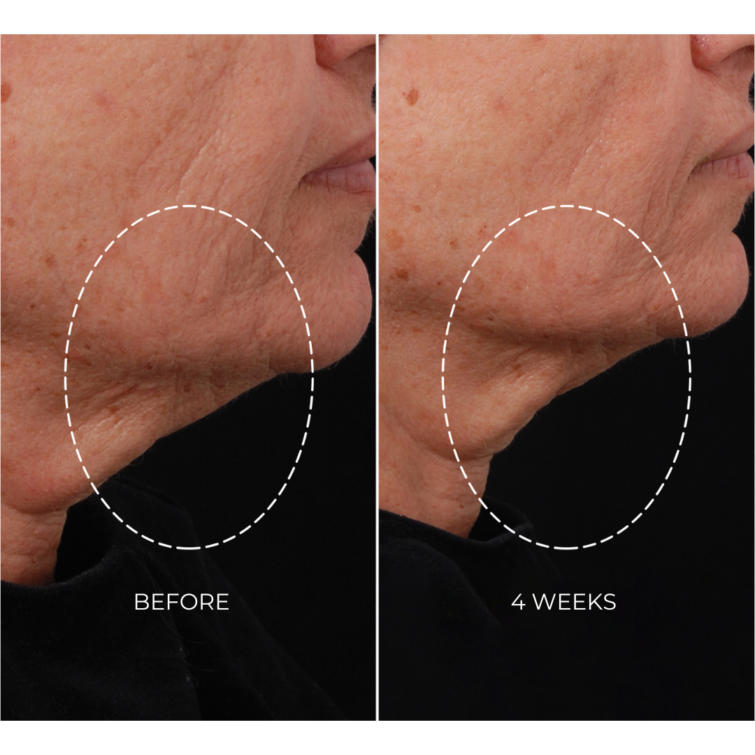 NEWA Classic RF Wrinkle Reduction Device